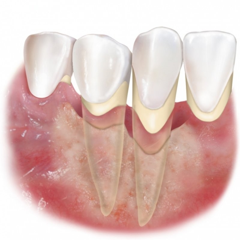 Пародонтит